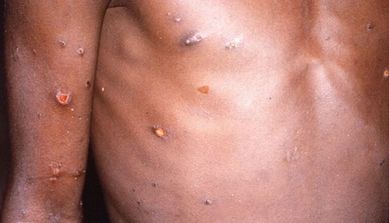 As per the guidelines, a confirmed case is laboratory confirmed for monkeypox virus by detection of unique sequences of viral DNA either by polymerase chain reaction (PCR) and/or sequencing.