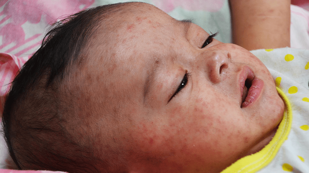 Centre deploys team of experts after Mumbai reports outbreak of measles The Theorist